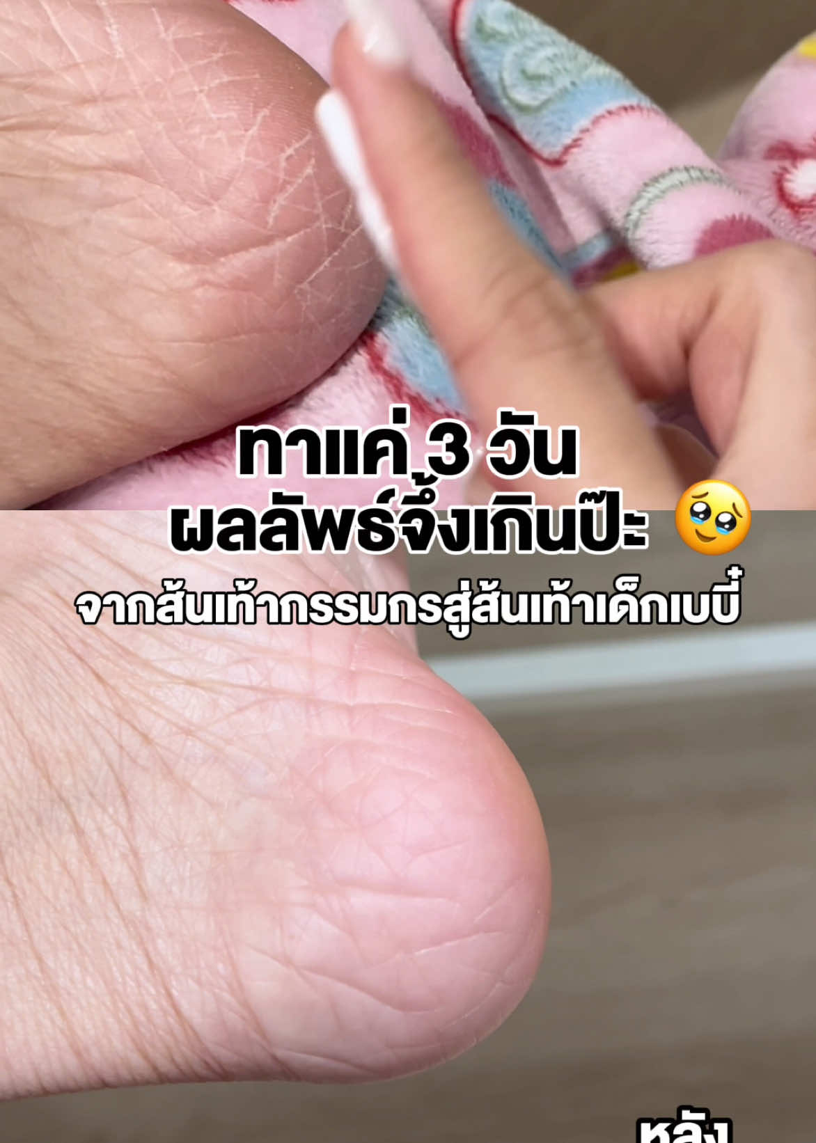 เกินไปปะ ใครส้นเท้าแตก แหก แบบดูไม่ได้ ทาด่วนค่ะ #ureacream #ยูเรียครีม #ส้นเท้าแตก #ศอดดำด้าน #u99renewalcream  