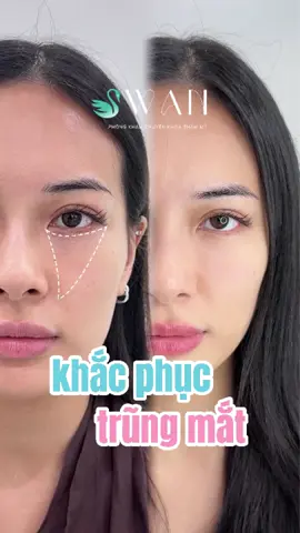 Có ngủ đủ, skincare đủ, makeup cũng rất kỹ nhưng trông gương mặt vẫn rất mệt mỏi. Nguyên nhân lại nằm ở vùng mắt trũng và quầng thâm. Khi hốc mắt bị lõm xuống, ánh sáng tạo bóng khiến vùng dưới mắt lúc nào cũng tối và thiếu sức sống. Chỉ cần cân chỉnh lại vùng trũng dưới mắt, gương mặt thay đổi khá rõ: ánh nhìn sáng hơn, quầng thâm dịu lại, vùng trũng được làm đầy và tổng thể trông tươi tắn hơn rất nhiều. 👉 GIẢM ĐẾN 58% cho dịch vụ trẻ hoá, inbox Swan ngay! _ _ _ _ _ _ _ _ _ _ _ _ _ _ _ _ _ _ _ _ _ _ _ _ 𝐒𝐰𝐚𝐧 𝐂𝐥𝐢𝐧𝐢𝐜 là phòng khám Chuyên khoa Thẩm mỹ, được cấp phép hoạt động chính thức bởi Sở Y Tế. Swan Clinic cung cấp các dịch vụ thẩm mỹ được thực hiện bởi đội ngũ Bác sĩ, Y tá, Chuyên viên tư vấn giàu kinh nghiệm. 𝐂𝐡𝐮𝐲𝐞̂𝐧 𝐊𝐡𝐨𝐚 𝐓𝐡𝐚̂̉𝐦 𝐌𝐲̃ | Nhận ngay ưu đãi khi đặt lịch tại đây :  Địa chỉ: 219Bis Nguyễn Thị Minh Khai, Phường Cầu Ông Lãnh, TP.HCM 📞 Hotline phản hồi: 093 437 3137 📞 Chăm sóc khách hàng: 094 1874 288 📞 Hotline tư vấn: – 094 1324 880 – 094 1326 880 – 094 1719 488