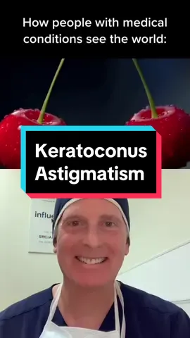 Keratoconus often causes astigmatism. Treatments are described on our site KeratoconusInserts.com #keratoconus 