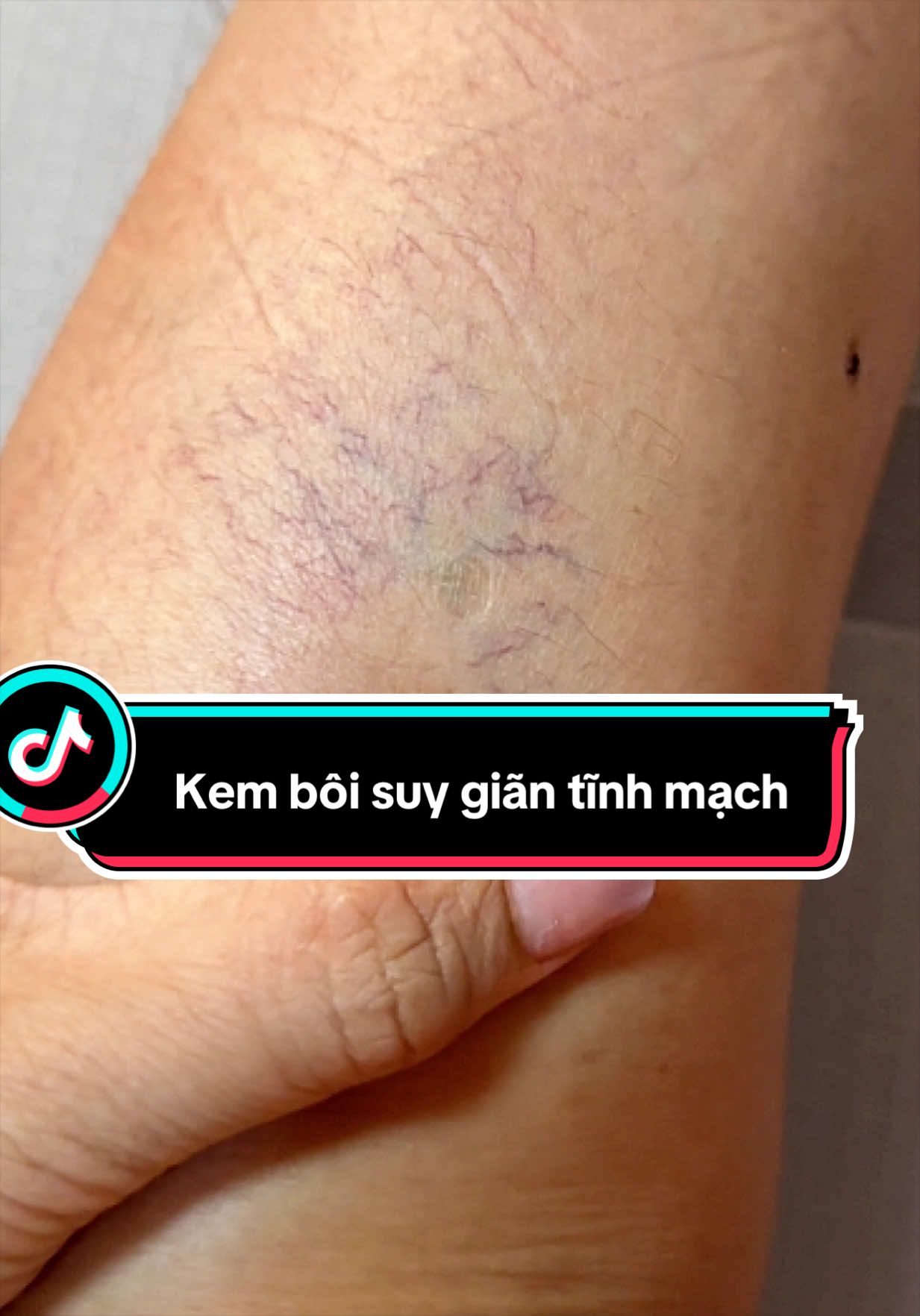 Kem bôi suy giãn tĩnh mạch , gân xanh đỏ nổi bất thường dưới da gây tê bì nặng nề #huynhphiyen #suygiantinhmach #kemboigiantinhmach #viraltiktok #xuhuong  @Huỳnh Phi Yến  @Huỳnh Phi Yến  @Huỳnh Phi Yến 
