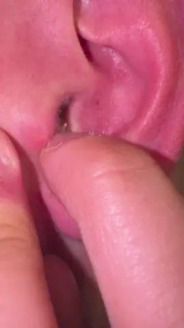 #pimplepopper #zits #pimples #fypシ #pimple 