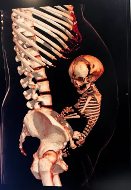 Reconstrução 3D óssea de tomografia computadorizada (TC)  de abdome total em paciente gestante de 32 semanas. Em contexto de emergência, a realização de TC de abdome e pelve em gestantes é indicada com base em avaliação de risco-benefício, considerando a exposição à radiação ionizante. #medicina #biomedicina #radiologia #gestante #fyp 