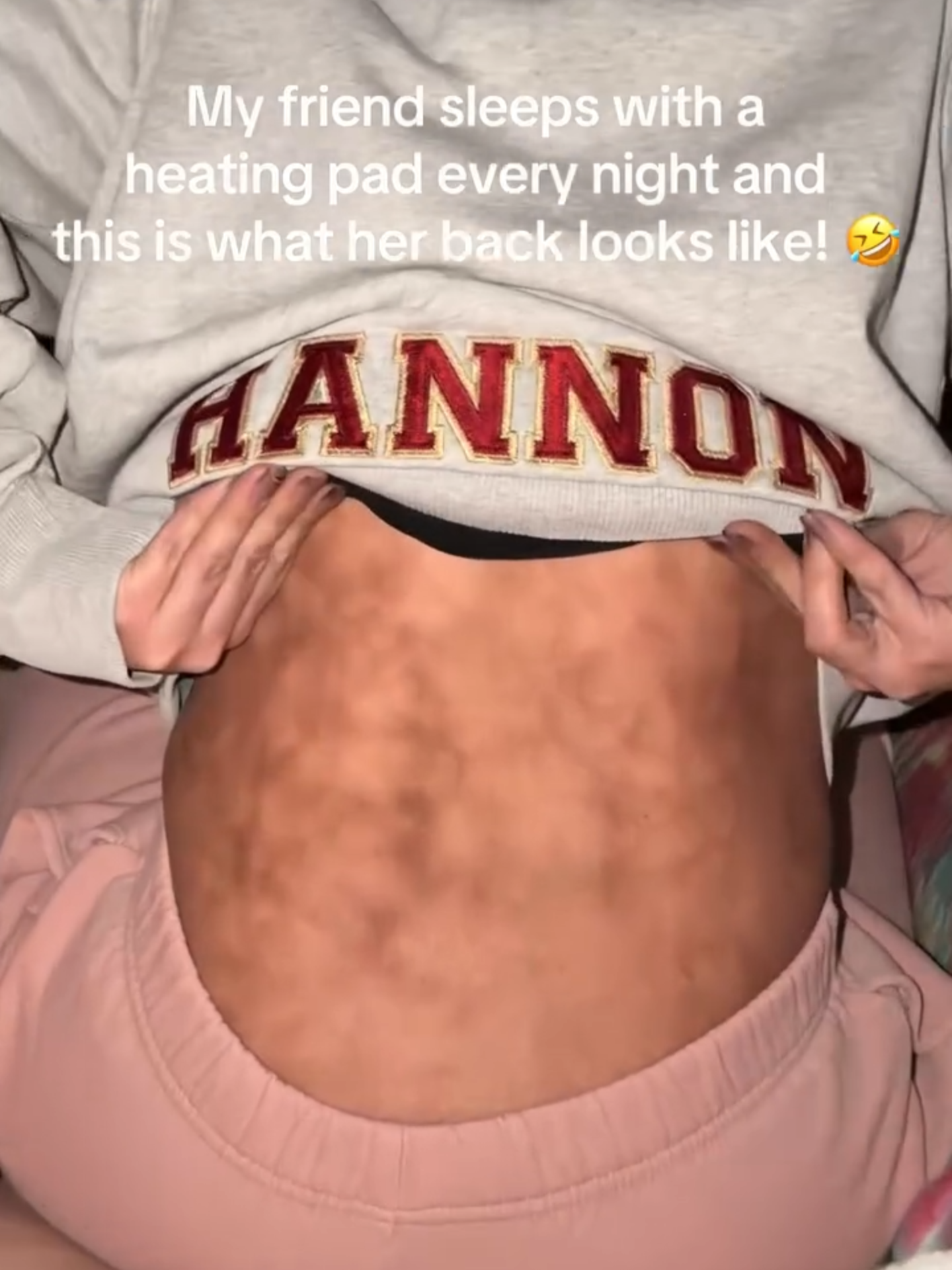 She slept with a heating pad every night. Now her back looks like this. 😳 It's called 