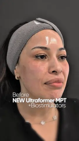 ✨NEW ULTRAFORMER MPT + BIOSTIMULATORS ✨ Discover the power of next-generation skin tightening with this advanced combination. Ultraformer MPT + biostimulators work together to lift, tighten, and regenerate your skin from within. ✨ Stimulates collagen ✨ Improves firmness ✨ Enhances skin quality ✨ Natural, progressive results 👀 Before & After results speak for themselves 📍 Available at Vive Med Spa 👉 Book your consultation and experience the difference. #ViveMedSpa #UltraformerMPT #Biostimulators #SkinTightening #BeforeAndAfter 