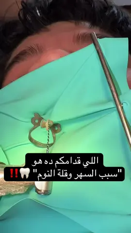 فن حشو العصب .. الدقة هي اللي بتفرق! 🎯🦷 سحب العصب بالكامل وبالشكل ده بيضمن لنا إن القنوات بقت نظيفة 100% وجاهزة للحشو النهائي. الراحة بتبدأ من اللحظة دي. ✨ #dental #اسنان #fypシ゚ 
