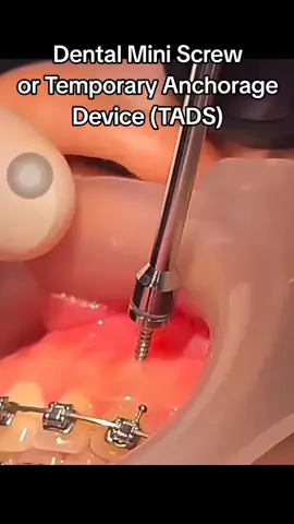 #blissdentalclinic #taichung #veneers #orthodontists #braces  @mon @Teacher Athena, PhD💙🦋 @ALBERT ALDAY🐰GNT PRODUCTION📸 
