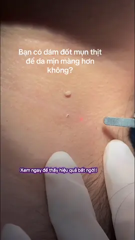 Trước đây bạn tự ti về mụn thịt? Giờ đây hãy đánh bay nỗi lo và lấy lại làn da mịn màng rạng rỡ chỉ với phương pháp này! Đừng bỏ lỡ cơ hội thay đổi #xoanotruoi #taynotruoi #xoamunthit #xoatannhang 