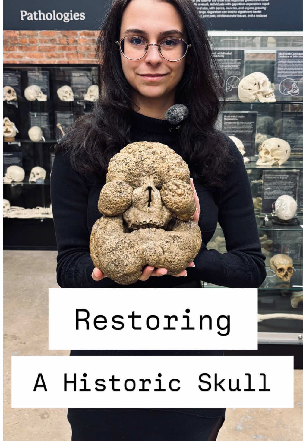 Restoration and long-term preservation are central to our mission at the Bone Museum. This skull with Leontiasis Ossea arrived after a failed repair using non-conservation materials that caused further damage. Removing them was a risk, but necessary. The result: a successful stabilization, ensuring the specimen is no longer at risk of continued deterioration.