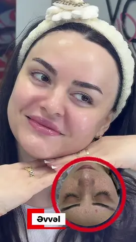 Xanımlar, dərinizə qulluq etməyin vaxtıdır! 💆‍♀️ Kollagen baxımı, üz təmizləmə (ciska), işıqlandırıcı maskalar və xüsusi baxımlar ilə dəriniz daha təmiz, parlaq və gənc görünsün. Gözəlliyinizə kiçik bir toxunuş, böyük bir fərq yaradır.” 🌸#keşfetteyiz #kolagen #baxim ✨🧿#keşfetteyi̇z #baximlixanimlar 