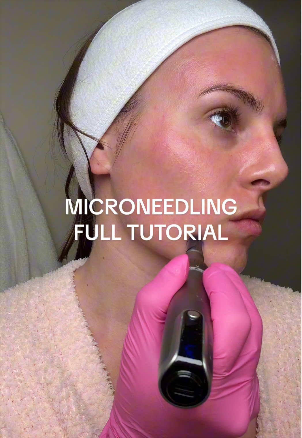 Full microneedling at home tutorial part 2: the process! #microneedling #microneedlingbeforeandafter #microneedlingresults #athomemicroneedling #microneedlingtutorial 