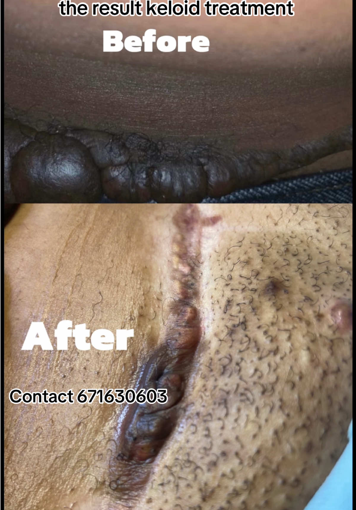 5 months later… look at this keloid transformation 😳🔥 Treatment process + final result at the end 🙌 Trust the process. #camerountiktok🇨🇲 #KeloidRemoval #KeloidTreatment #BeforeAndAfter  #SkincareResults