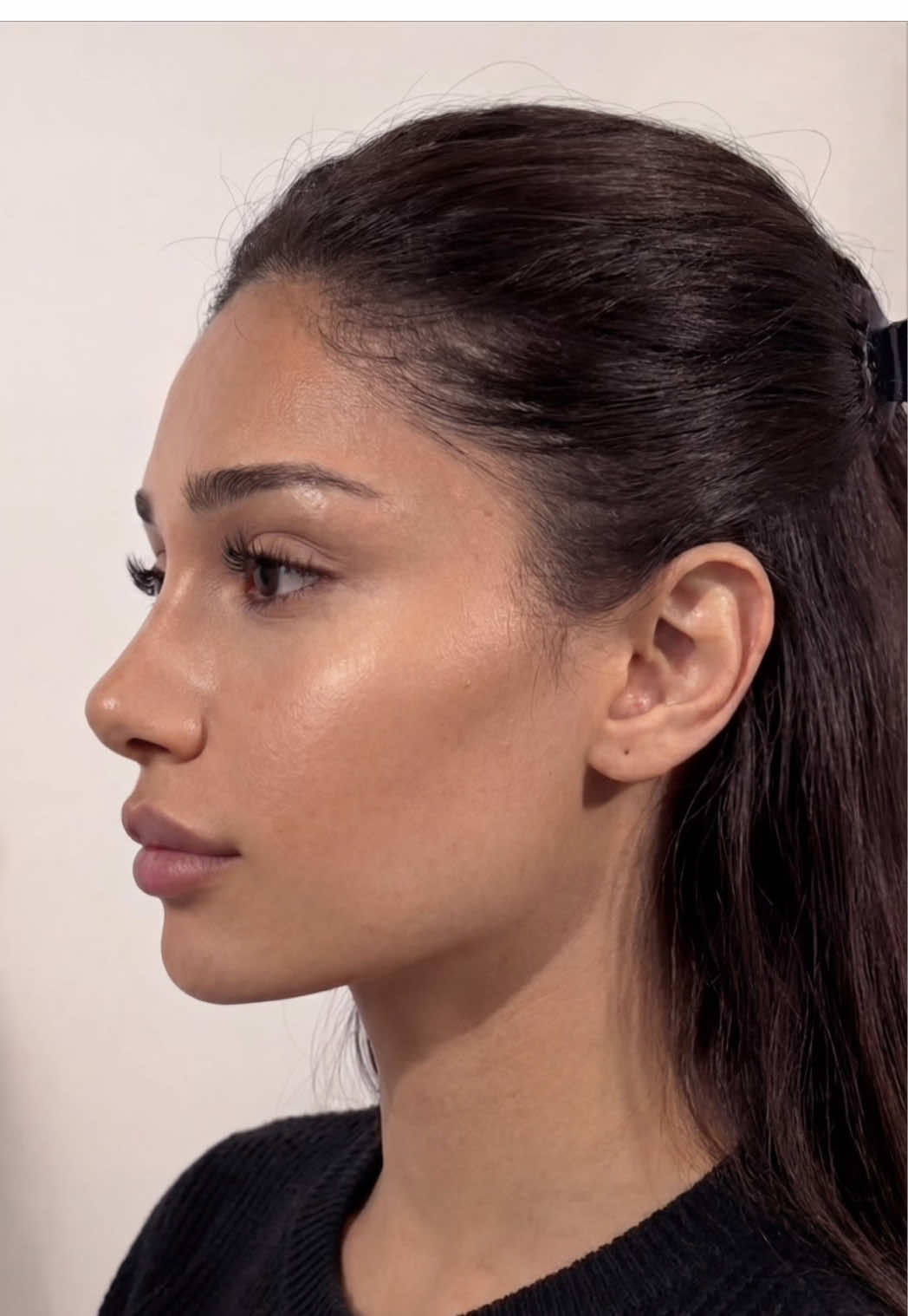 Well-placed fillers aren’t about “adding volume everywhere.” They’re about enhancing anatomy, restoring lost volume, and creating balance in the right areas. Now add a calorie deficit — and you get a double effect: the face becomes more defined, excess fullness goes away, and the fillers look even cleaner, sharper, and more natural. It’s the combination of: ✨ precise placement ✨ a controlled calorie deficit that creates that “expensive” look — fresh, sculpted, and harmonious without being overdone.