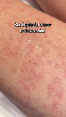 Ficaste com a pele cheia de bolinhas vermelhas logo a seguir à tua sessão de laser? Calma, não há motivo para pânico. Na verdade, devias estar a celebrar! Esse efeito, que chamamos de edema perifolicular, é a prova visual de que a magia aconteceu. E tudo isto acontece graças a uma coisa chamada fototermólise. Pode parecer um nome complicado, mas na prática é o teu melhor amigo nesta jornada. Sem grandes chatices científicas, a fototermólise funciona assim: o laser foca-se na cor do teu pelo, viaja num piscar de olhos até à raiz e usa o calor para a destruir por completo. Quando essa raiz é eliminada com sucesso, o teu corpo reage com esse pequeno inchaço em cada poro. Ou seja, aquelas bolinhas vermelhas não são uma alergia nem um problema. São o troféu que prova que o tratamento atingiu o alvo em cheio! É exatamente este o sinal que procuramos e que te garante que estamos a fazer uma depilação definitiva. Aquele pelo específico foi fulminado e não tem qualquer hipótese de voltar a crescer. Da próxima vez que vires a tua pele assim, já sabes: é apenas o teu corpo a despedir-se das giletes, das ceras e da preocupação com os pelos, para te dar uma pele lisa para sempre. Já te tinha acontecido isto depois de uma sessão ou achavas que era alergia? Conta-me aqui nos comentários! #depilaçãoalaser #ovar #mitoseverdadeslaser #depilação #hairremoval