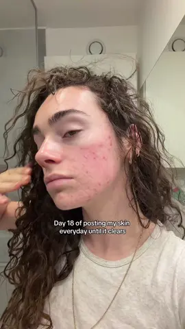 On y est presque j’ai l’impression hihi avec ma tête du matin là mdr #acneproneskin #acnepositivity #acnescars #acnejourney #clearskin 