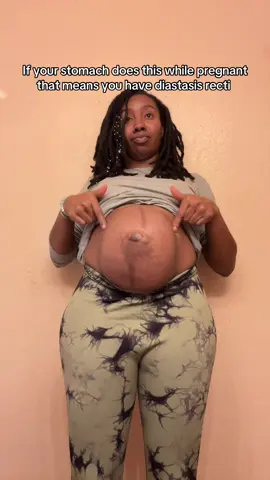 My 2nd pregnancy gave me DR then I never really got it fixed and then 5 years later 4 more pregnancy it got worse each one i probably hav like a 8-10 finger gap from my abdominal muscles #diastasisrecti #pregnancy #dr #fyp #foryoupage 