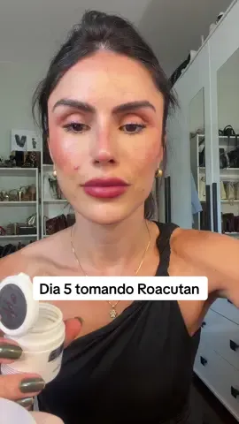 #roacutan #acne 