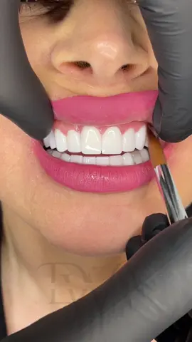 💎True aesthetics lie in the details. At DentalWorldTR, every smile is crafted like a work of art. 📍 With our team of experts in Hollywood Smile, implants, and zirconium, we bring you a radiant, confident smile. ✨ 📞+905050228448 #LuxurySmileMakeover #SmileTransformation #hollywoodsmileturkey #crowns #ZirconiumCrownsTurkey  