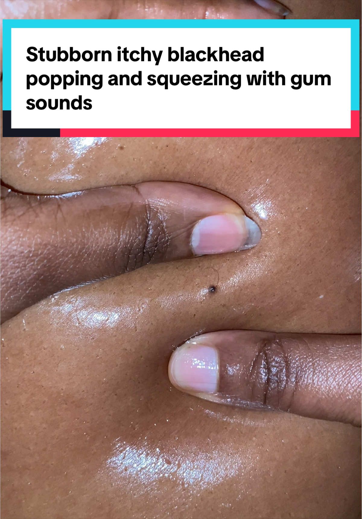 #viral #fyp #trending #asmr #blackheadremoval 