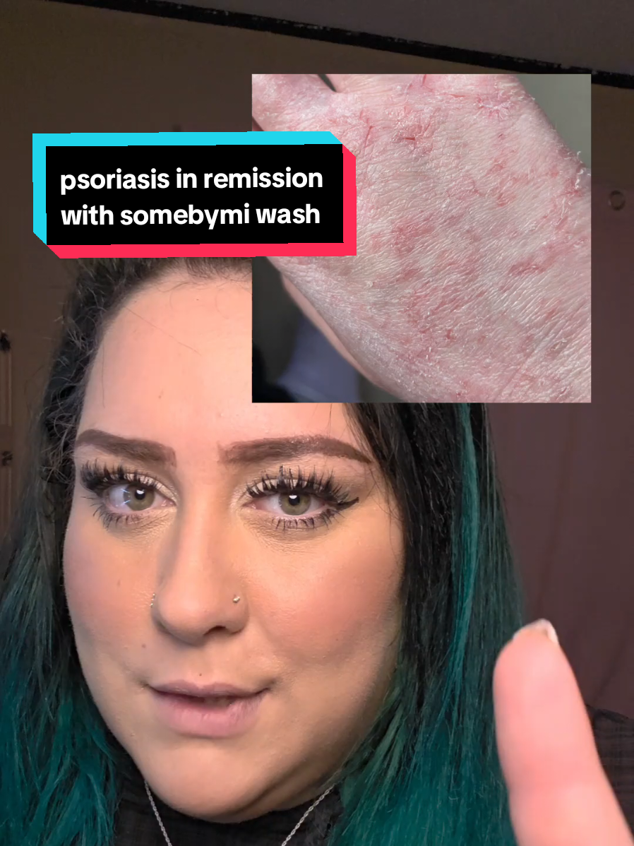 Replying to @gabyc250  let me know if you try it!! id love to hear about your results ❤️ #somebymi #psoriasis #hidradenitissuppurativa #bodyacne #backacne 