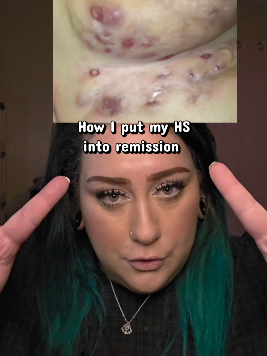 Replying to @ayomaeee let me know if u try it ❤️ and i wish u the best of luck on your skincare journey 🥺❤️ #backacne #bodyacne #hidradenitissuppurativa #somebymi #bodywash 