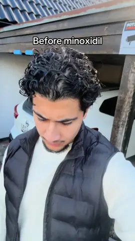 There’s been a lot of trial and error over the years, but in the end I found the right routine. Minoxodil is your best friend when its comes to regrowth. Do you have experience with minoxidil?? Drop a comment how it has worked for you!  #hairtok #androgenicaalopecia #hairloss 