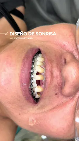 Rehabilitación estética con resultados naturales 🦷✨ Combinamos un diseño de sonrisa con dos puentes Maryland, logrando reemplazar piezas dentales de forma fija, conservadora y mínimamente invasiva 🤍 Este tipo de tratamiento permite devolver función, estética y armonía sin comprometer la estructura de los dientes vecinos Precisión, planificación y resultados que se integran de forma natural ✨ 📍 Guayaquil, Ecuador 📲 Agenda tu valoración ⸻ #laydent  #PuenteMaryland #DiseñoDeSonrisa #estéticadental 