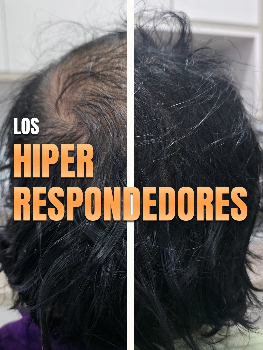 ¿Resultados en 3 meses? 🤯💇‍♂️ Sí, existen… pero no todos los pacientes responden igual. En medicina capilar hay un grupo llamado hiperrespondedores 🧬 Personas que, gracias a su genética, logran resultados extraordinarios en poco tiempo. ⚠️ Pero aquí está la clave: Aunque 2 pacientes sigan el mismo tratamiento… 👉 los resultados pueden ser completamente diferentes Por eso es fundamental un diagnóstico objetivo 🔬 📲 Agenda tu evaluación especializada: 977 133 990 / 987 575 649  #alopecia #saludcapilar #caidadecabello #dermatologia #drenriquemalpartida