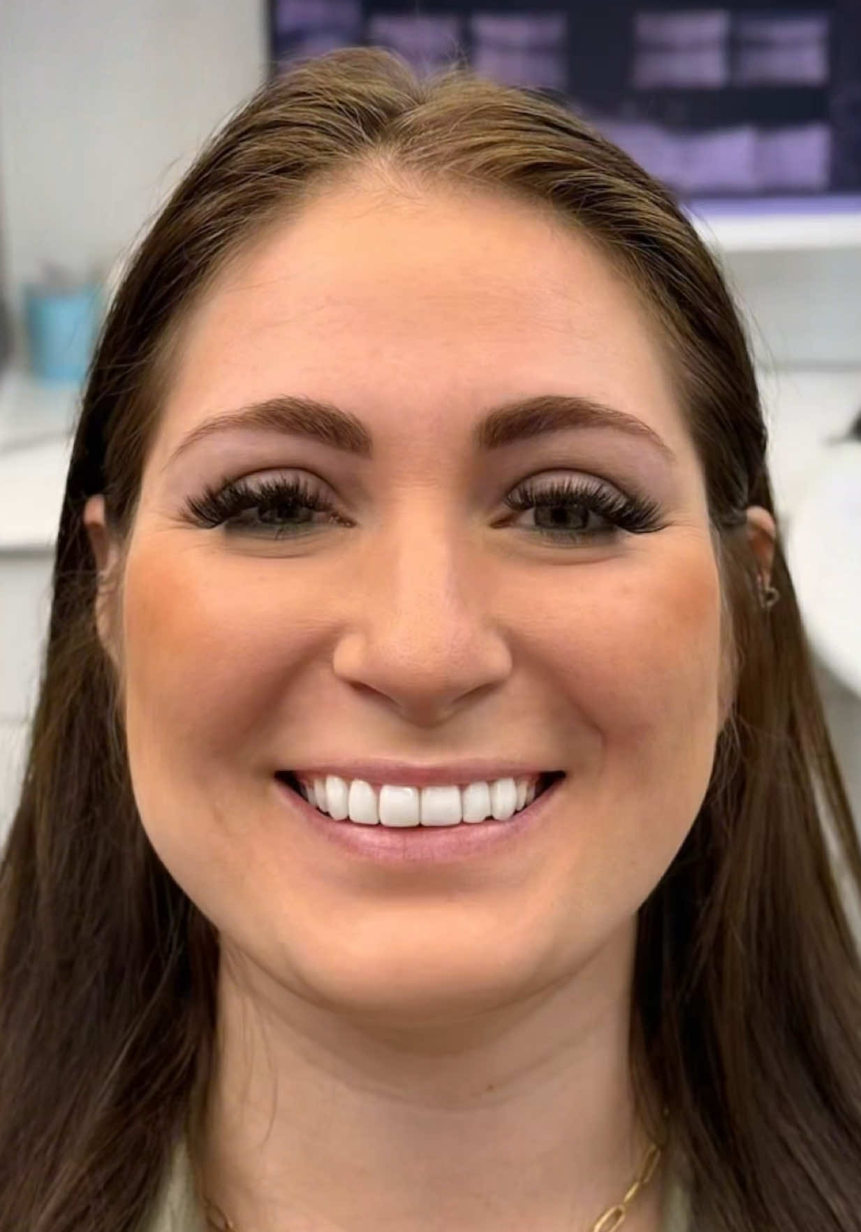 Big ole’ veneers….not even the worst part. A deep bite is the biggest problem here. They are the cause of so many issues like clenching/grinding, jaw pain, too small of teeth, too big of teeth, or just teeth that are not fun to look at….but there is finally a solution. I hope this changes the world. It already has for so many that have passed through these Texas doors. Literally over night…..