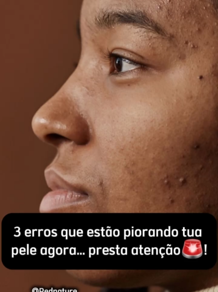 Se estás a fazer isso… estás a piorar tua própria pele. E o pior: a maioria faz esses erros todos os dias… sem perceber. Lavas demais. Misturas produtos. Mexes na espinha. Resultado? Mais acne. Mais manchas. Mais frustração. Se queres parar de errar e começar a melhorar tua pele: 📩 envia mensagem agora ou comenta PELE ✔ Comenta “PELE” ✔ Envia mensagem ✔ Guarda este vídeo #acnetratamento#cuidadoscomapele #peleoleosa🇦🇴#angola#luanda