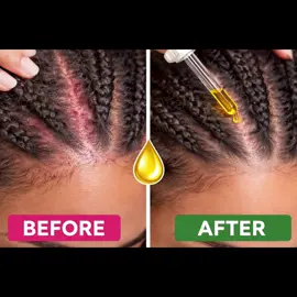 ✨Crownrelief.store✨ Check out our Instant relief Oil for Braids and extensions! Calling ALL BRAIDERS this product is 🔥🔥🔥 #musthaveproduct #braidproducts #tenderheaded 
