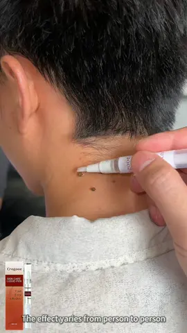Its effects extremely impressive#fyp #TikTokShopRestock #tiktok #tiktokshop #wart 