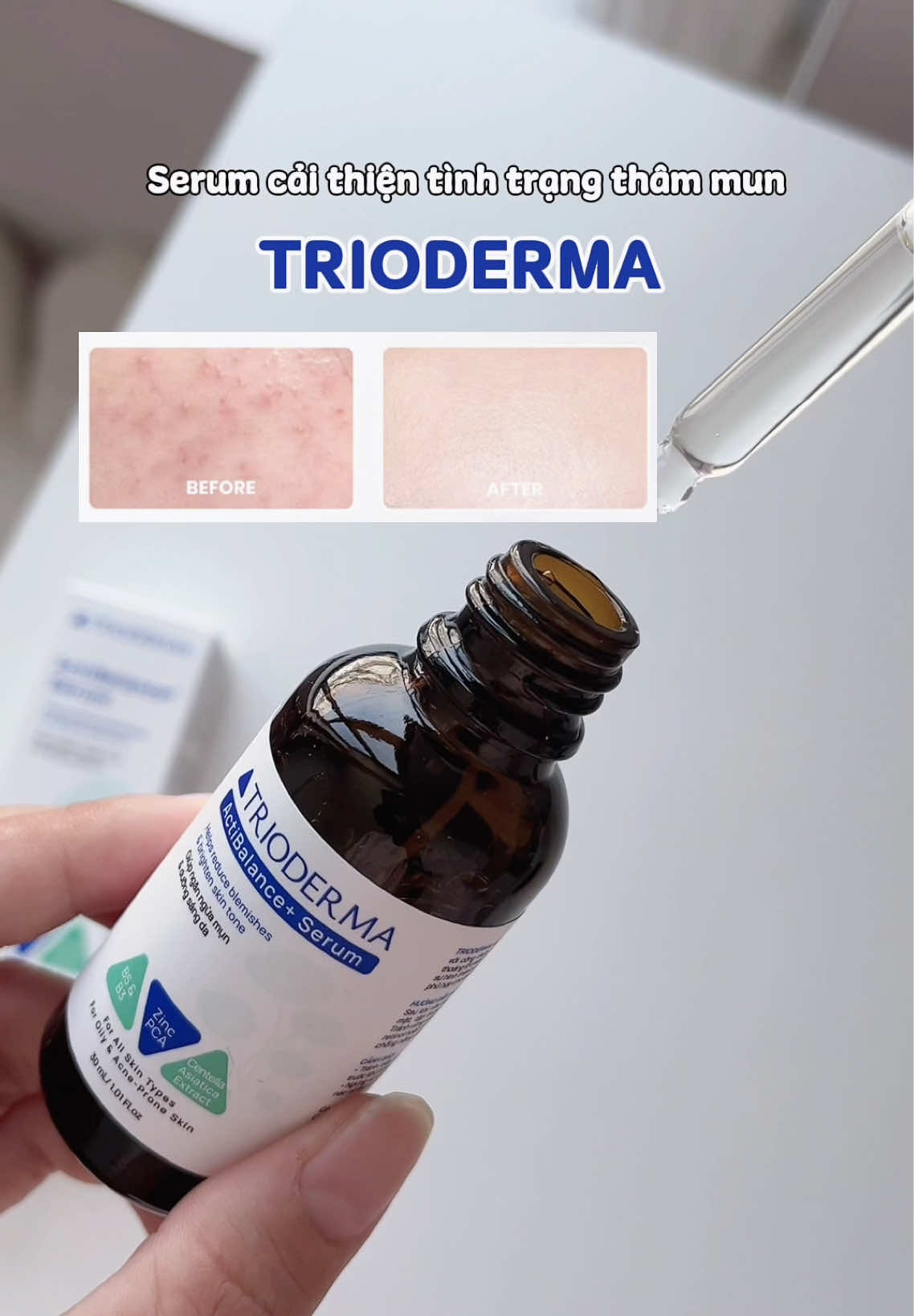 Bà nào da dầu mụn viêm mụn ẩn thì thử serum Trioderma ActiBalance nha giúp cải thiện mụn, mờ thâm, kiềm dầu ✨ #trioderma #serumtrioderma #dadaumun #serumgiammun #serummun 