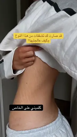 سيروم التشققات والخطوط البيضاء بالجسم سيروم مركز وفعال لعلاج  التشققات وخطوط الجسم بعد التخسيس او بعد الولاده والخطوط والتشققات المزعجه للوزن الزائد ..الحل عندي في سيروم مخلوط من مكونات هامه جدا لاعادة ترميم الجلد وعلاج التشققات وخطوط السيلوليت  تحتوي على كولاجين وايلاستين وفيتامين اي و ايه وسي مع خلاصة الصبار  اطلبي الان وتخلصي مما يؤرقكك  مجربه ومضمونه الحمد لله  وماتتعارض مع اي شي ومالها اثار سلبية #منتجات_لوميرا #تشققات_الجسم #الخطوط_الحمراء_والبيضاء #سيلوليت_شد_الجسم_التخلص_من_الترهل 