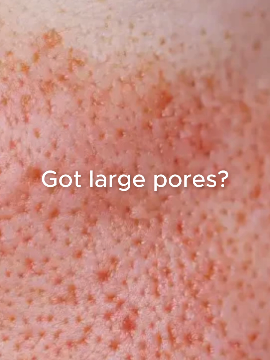 POV: Your pores finally met their match. Meet our new Combo F: Pore Refining Treatment ✨ Designed to control oil, clear congestion, and visibly refine pores—so your skin looks smoother, clearer, and healthier.  Your next facial? Upgraded. 😉 Now available in all Kskin branches. #KskinPhilippines #PoreMinimizing #SkinClarity #ExpressGlow #FacialUpgrade