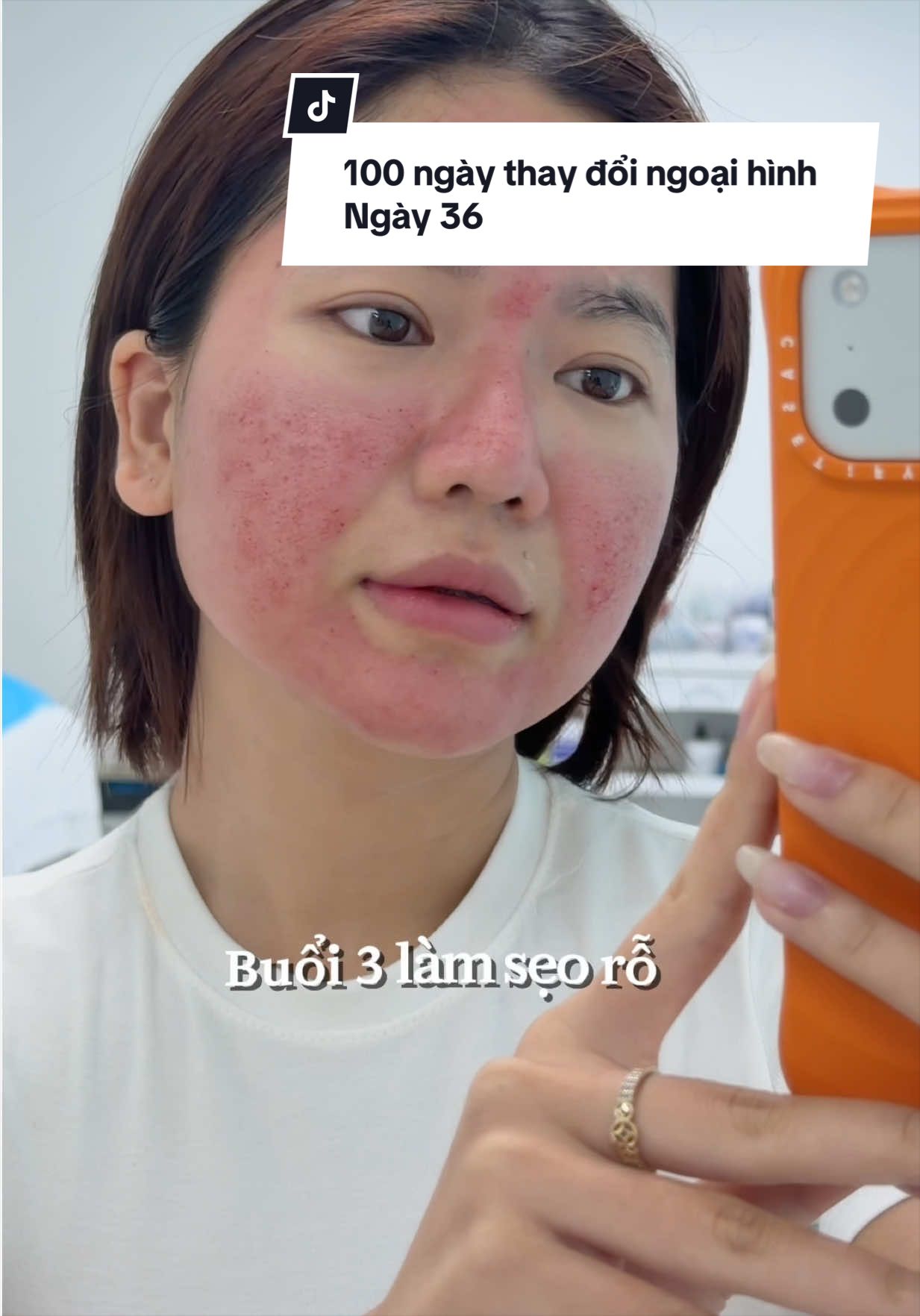 100 ngày thay đổi ngoại hình ngày 36. Buổi 3 đi làm sẹo sos #conghuongtunek #VULACI #xuhuong #foryou 