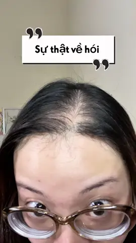 Mấy bà có ai đang vật lộn với tình trạng rụng tóc hói đầu lâu năm giống Nga không #hairloss #haircareroutine #hazelnga #beautytoks 
