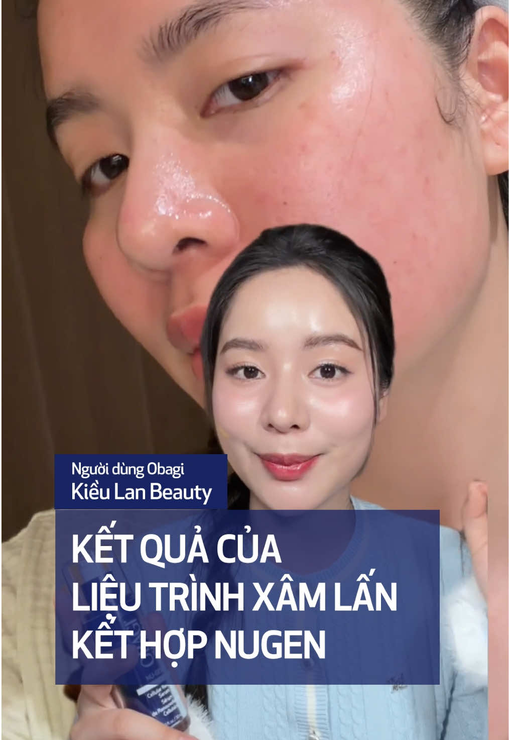Kết hợp Obagi NU-GEN™ sau liệu trình xâm lấn là cách Kiều Lan Beauty tối ưu kết quả trên da – mịn màng, săn chắc và phục hồi ổn định hơn sau treatment. 🔹 Sản phẩm được chứng minh qua 3 nghiên cứu lâm sàng trên 111 đối tượng đánh giá, an toàn với mọi làn da Việt.  #ObagiMedicalVietnam #NUGEN #NAD #TreHoaTeBao #TreHoaDa 