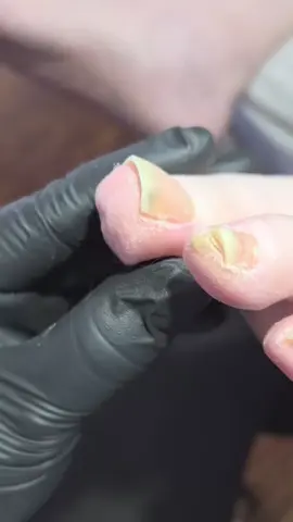 ¿Uñas amarillas, gruesas o dañadas? 😖 Podría tratarse de onicomicosis (hongos en las uñas). En MR. PIE contamos con láserterapia, un tratamiento seguro, indoloro y efectivo que actúa directamente sobre el hongo, ayudando a recuperar la salud y apariencia de tus uñas 🦶✨ 💥 Incluye: ✔️ Sesiones de láser ✔️ Quiropodia ✔️ Desinfección de calzado ✔️ Seguimiento profesional ✨ Resultados progresivos desde las primeras sesiones 📩 Agenda tu evaluación y empieza tu tratamiento hoy #Laserterapia #Onicomicosis #Podologia #MRPIE #PiesSanos 