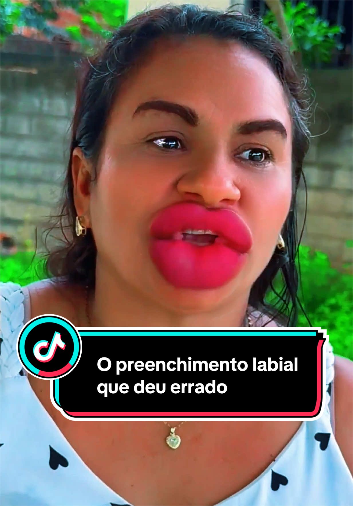 O preenchimento labial que deu errado 