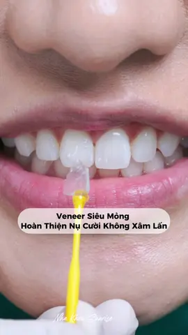 Veneer Siêu Mỏng Hoàn Thiện Nụ Cười Không Xâm Lấn #myhanhdentist  #nhakhoasunrise #fyp  #veneers 