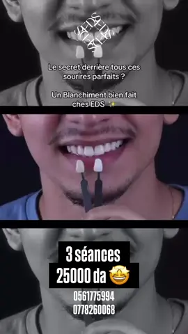 Blanchiment dentaire 3 séances à 25000 da #blanchimentdentaire #dentiste #alger #تبييض الاسنان بالمايكرو 0561775994 ou 0778260068  🇩🇿 