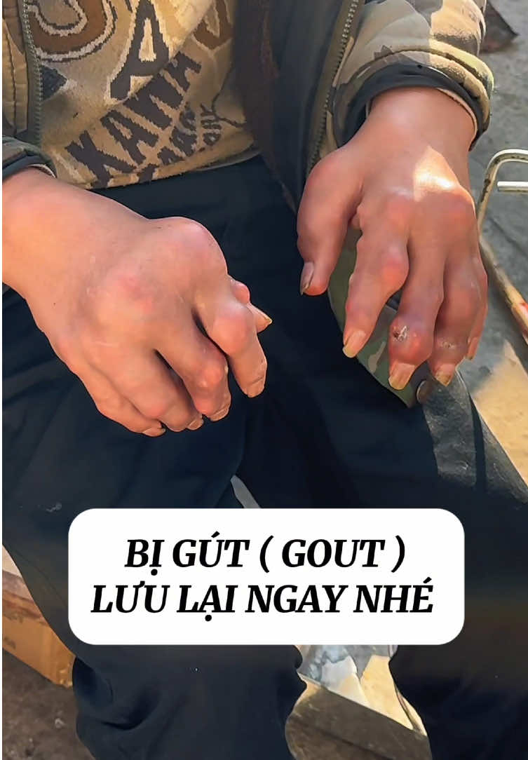 #gout #daunhucxuongkhop #baithuochay #baithuocdangian #xuhuong 