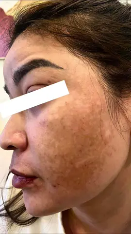 Cải thiện làn da nám mảng, đốm nâu, tăng sắc tố với Laser Pico cho hiệu quả như thế nào #xh #spadanang #laserpico #dieutrinam #leospa 