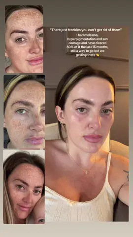 My pigmentation wasn’t just freckles it was melasma and hyperpigmentation and yes you can clear it 👏 #pigmentation #melasma #skincareclinic #pigmentationtreatment #sundamage 