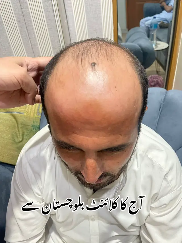 #besthairtransplant #irshadwazir #hairrenewal #tiktokviral #foryoupage 