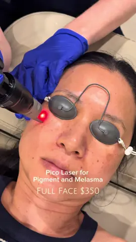 Full face Pico laser treatment for concerns including pigmentation and melasma. Treatment suitability is determined during a complimentary consultation with our registered nurses prior to booking. Price listed is for laser with our registered nurses.  Consultations available via the link in bio. 📍 Brisbane. #pigmentation #melasma #picolaser #brisbaneskinclinic 