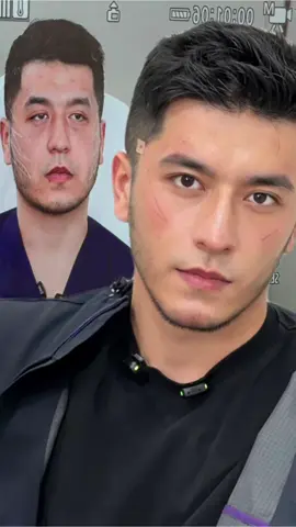 Do you prefer before or after surgery? #Facial Lift #Anti-Aging #Facial Firming #Looking Handsome #Handsome Guy