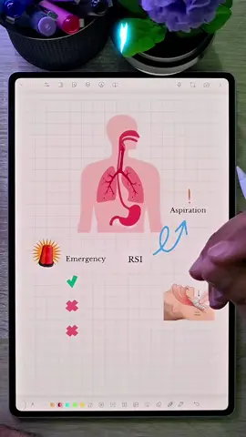 توضيح Rapid sequence induction وتجنب حصول Aspiration أثناء التخدير العام GA #تخدير  #anesthesia 