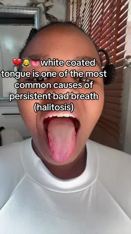 White coated tongue 👅 #badbreath #mouthodour😷 #viralvideo #fyyyyyyyyyyyyyyyyyyy #trend 