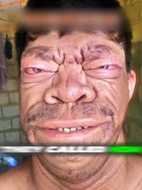 The Story Behind “The Ugliest Man” in the PH ##Commentary #Storytelling #ViralStory #tiktokcommentary #RareCondition